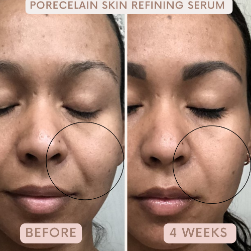 Auve Beauty porecelain skin refining serum before and after