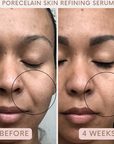 Auve Beauty porecelain skin refining serum before and after
