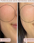 Auve Beauty skin refining serum results