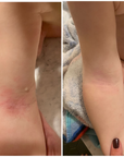 Before and after comparison of a person's arm with visible redness on a towel background.