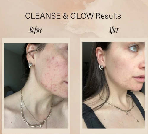 Before and after comparison of facial skin with text 'Cleanse & Glow Results' on a beige background.