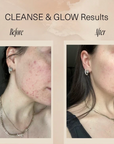 Before and after comparison of facial skin with text 'Cleanse & Glow Results' on a beige background.