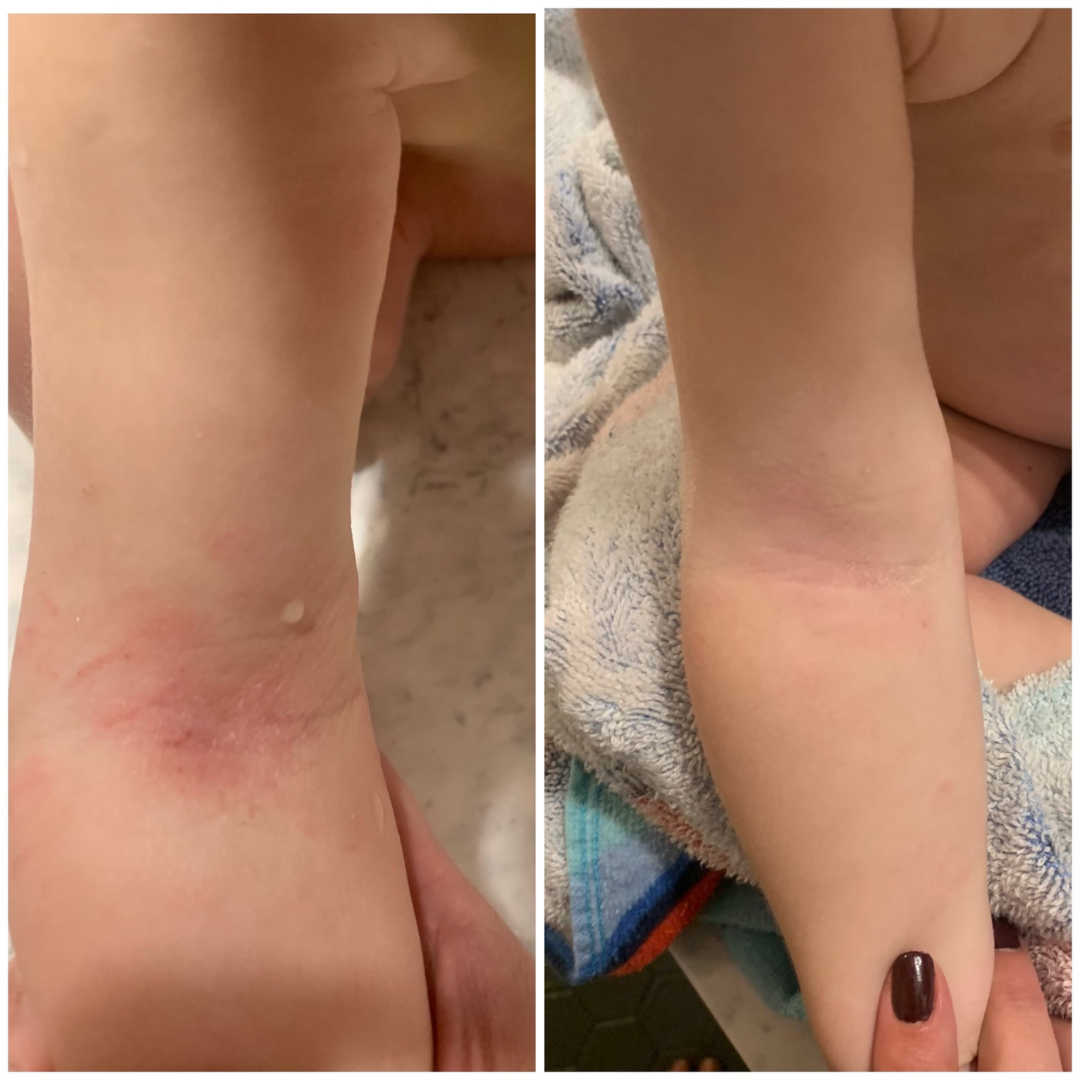 Before and after comparison of a person's arm with visible redness on a towel background.